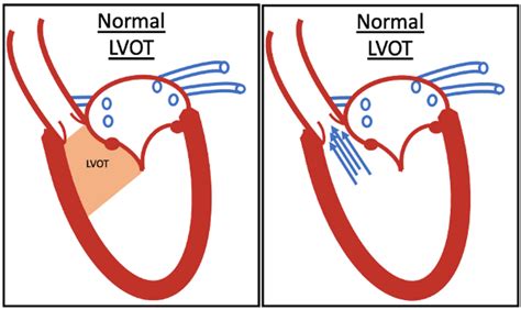 lv outflow obstruction|left ventricular outflow obstruction causes.